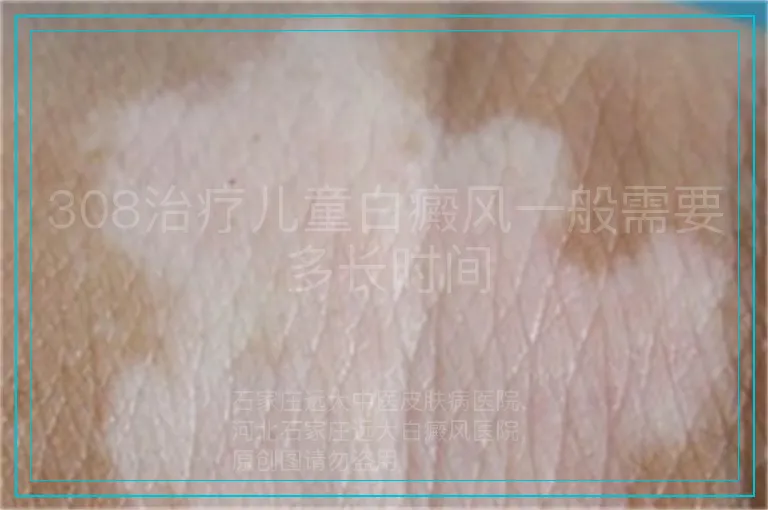 308治疗儿童白癜风一般需要多长时间