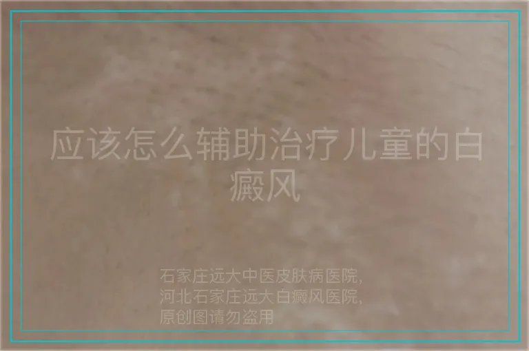 应该怎么辅助治疗儿童的白癜风