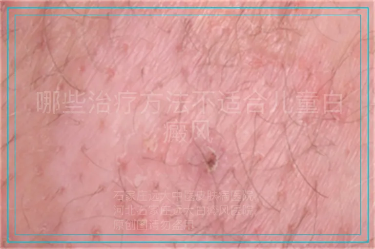 哪些治疗方法不适合儿童白癜风