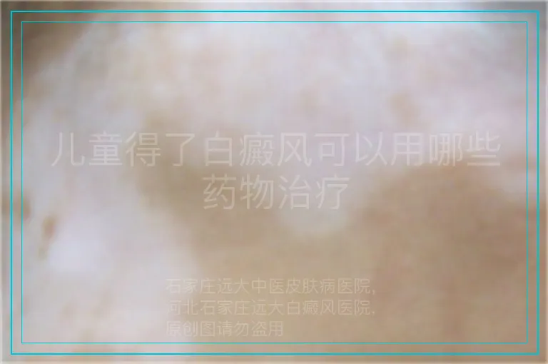 儿童得了白癜风可以用哪些药物治疗