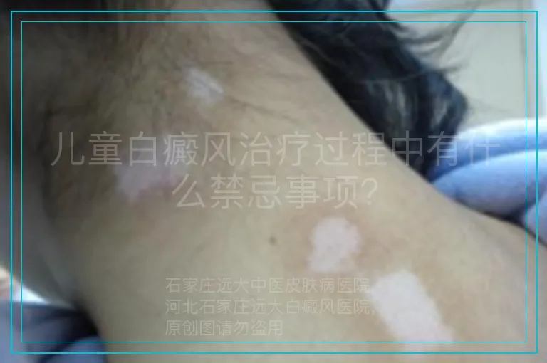 儿童白癜风治疗过程中有什么禁忌事项?