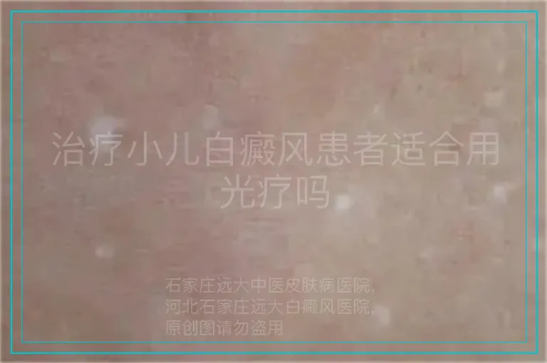 治疗小儿白癜风患者适合用光疗吗