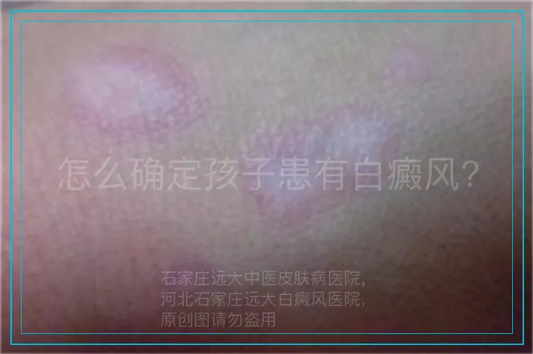 怎么确定孩子患有白癜风?