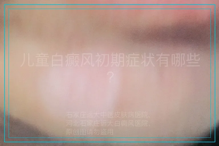 儿童白癜风初期症状有哪些?