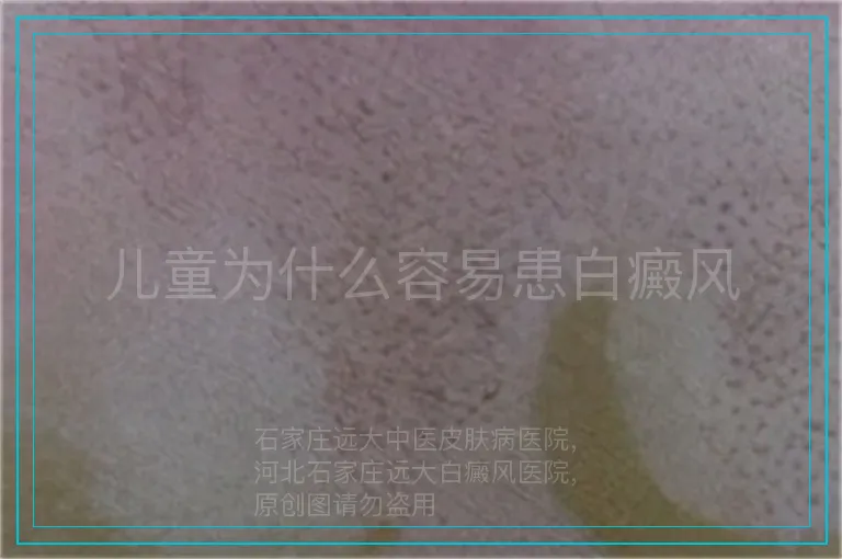 儿童为什么容易患白癜风