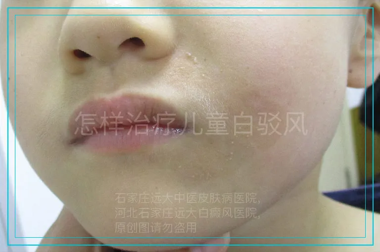 怎样治疗儿童白驳风