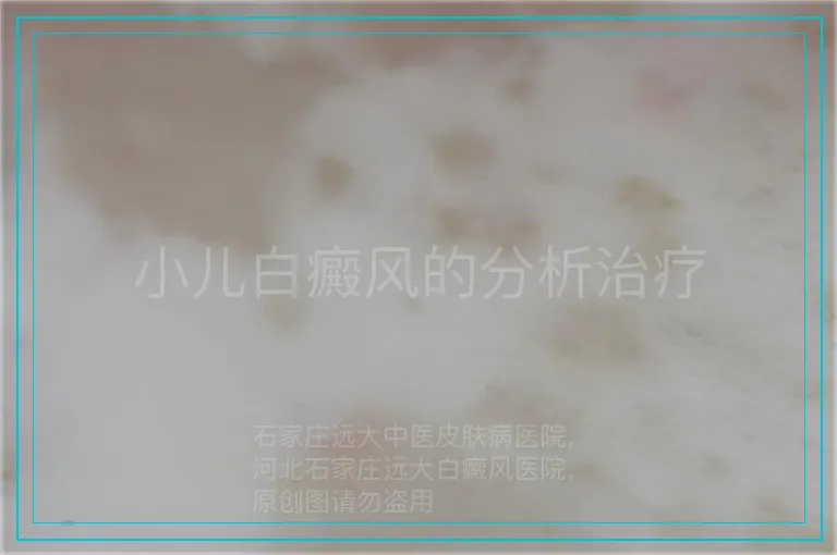 小儿白癜风的分析治疗