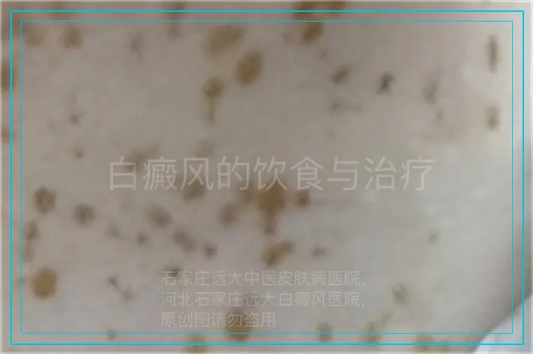 白癜风的饮食与治疗