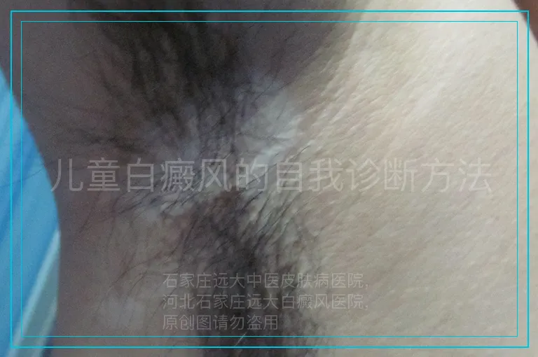 儿童白癜风的自我诊断方法
