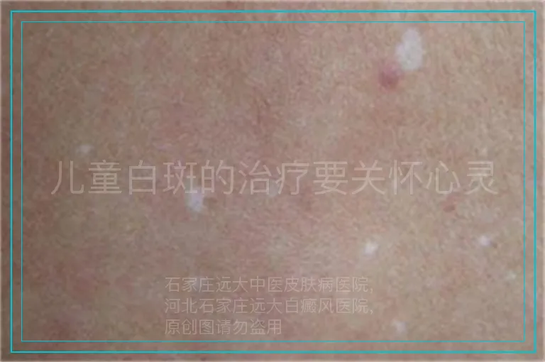 儿童白斑的治疗要关怀心灵