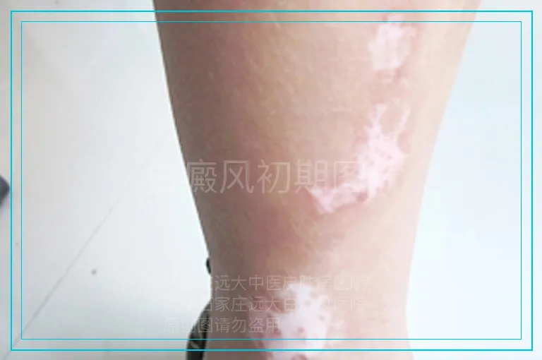 白癜风初期图片