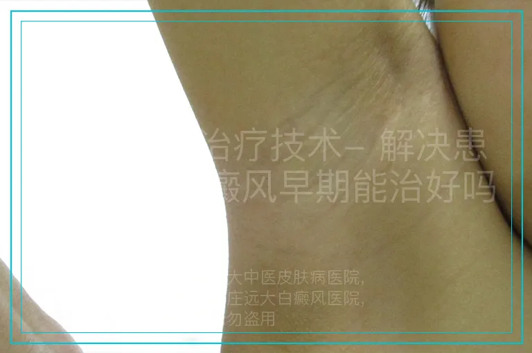 白癜风新治疗技术- 解决患者疑问“白癜风早期能治好吗”