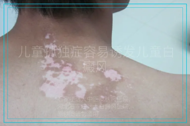 儿童孤独症容易诱发儿童白癜风
