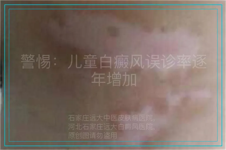 警惕：儿童白癜风误诊率逐年增加