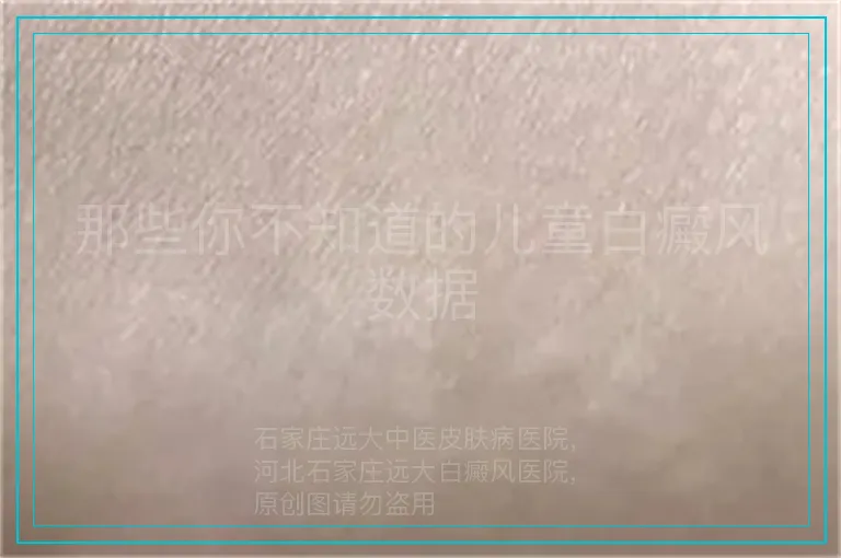 那些你不知道的儿童白癜风数据