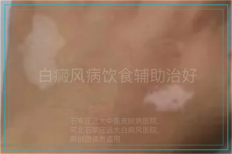 白癜风病饮食辅助治好
