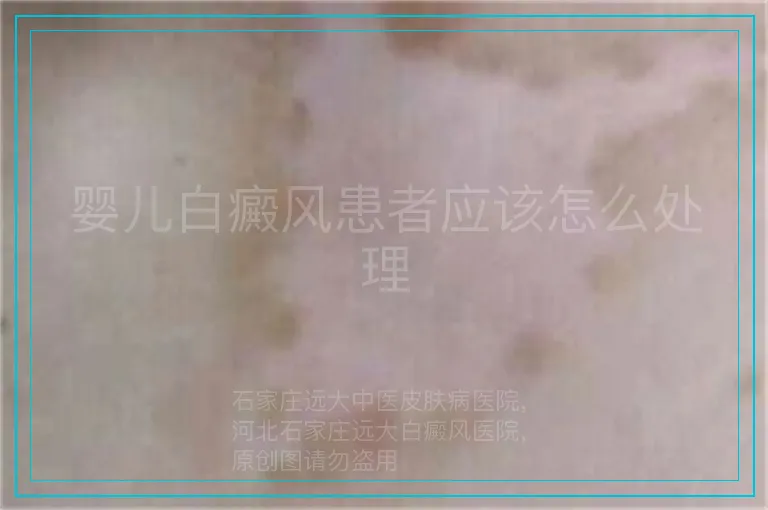 婴儿白癜风患者应该怎么处理