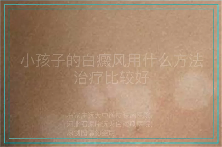 小孩子的白癜风用什么方法治疗比较好