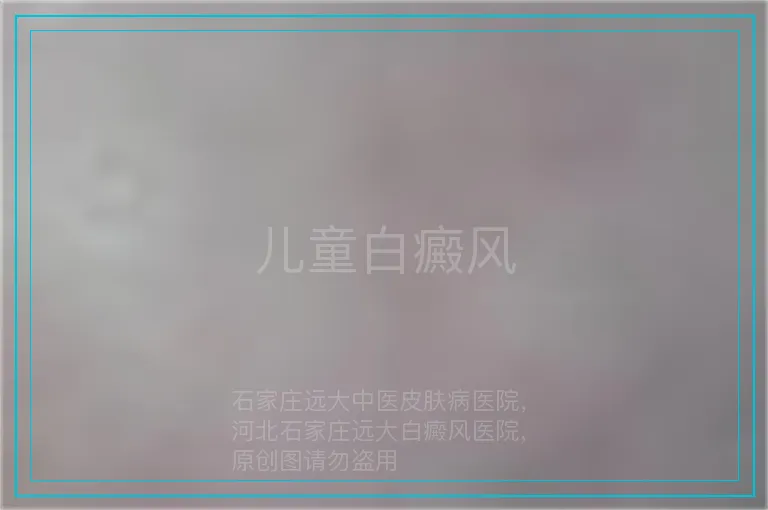 儿童白癜风