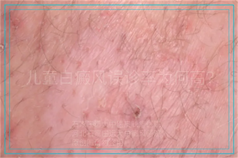 儿童白癜风误诊率为何高？