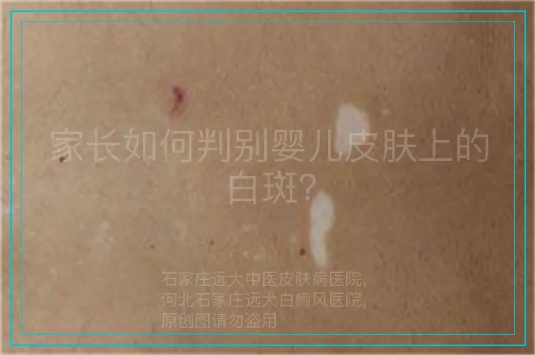 家长如何判别婴儿皮肤上的白斑？
