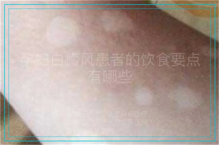 孕妇白癜风患者的饮食要点有哪些