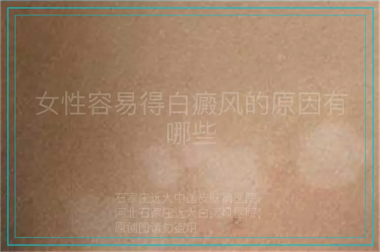 女性容易得白癜风的原因有哪些