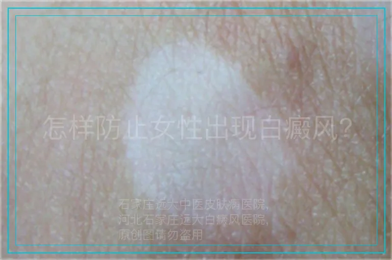 怎样防止女性出现白癜风?