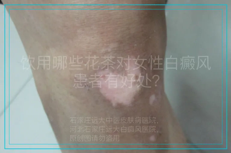 饮用哪些花茶对女性白癜风患者有好处？