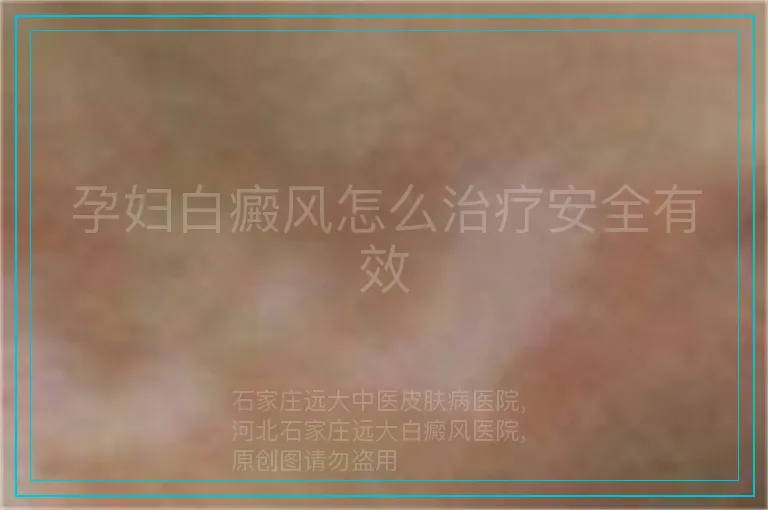 孕妇白癜风怎么治疗安全有效