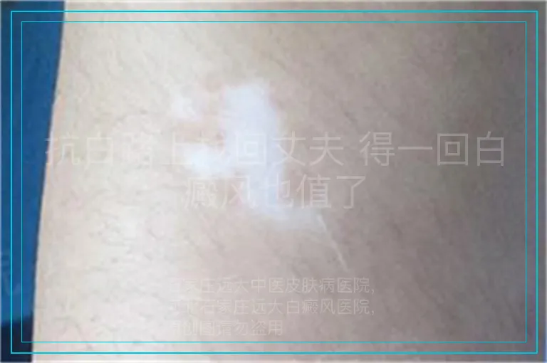 抗白路上找回丈夫 得一回白癜风也值了