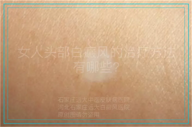 女人头部白癜风的治疗方法有哪些?