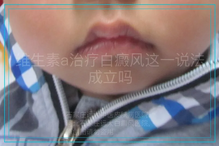 维生素a治疗白癜风这一说法成立吗