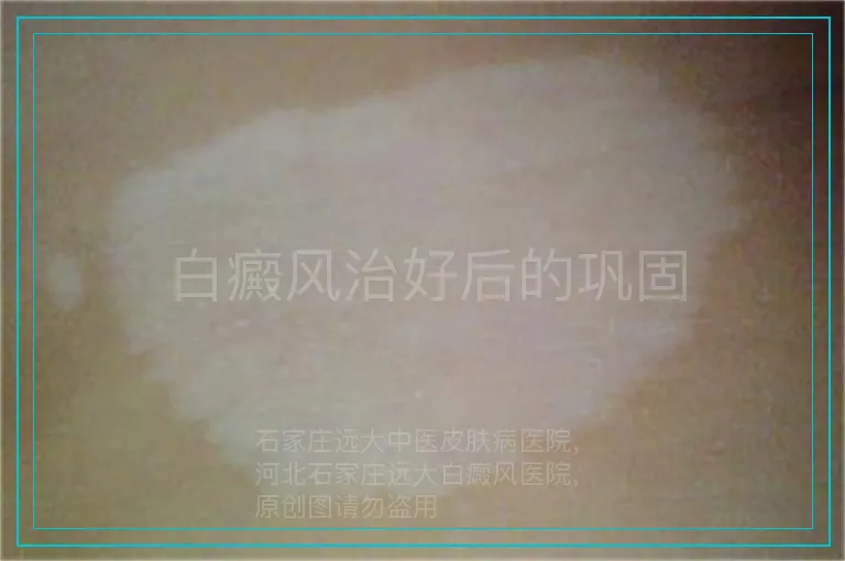 白癜风治好后的巩固