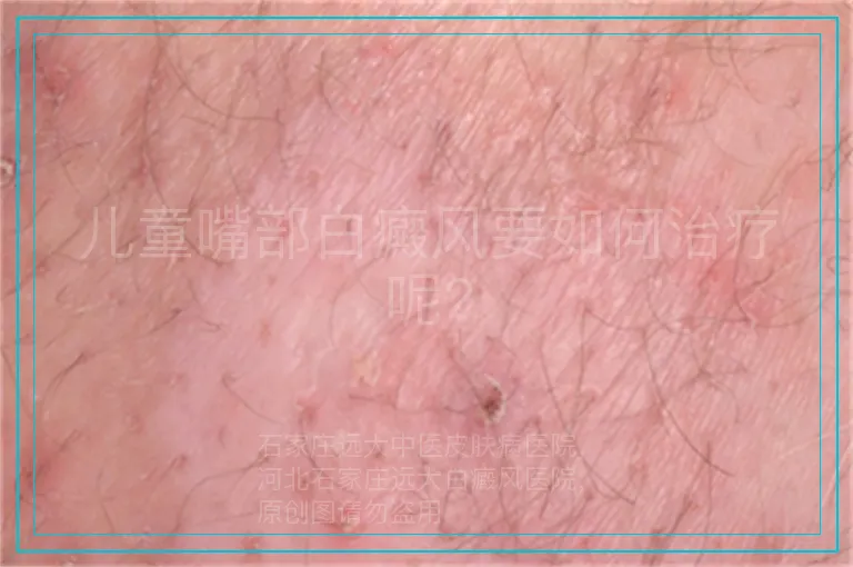 儿童嘴部白癜风要如何治疗呢?