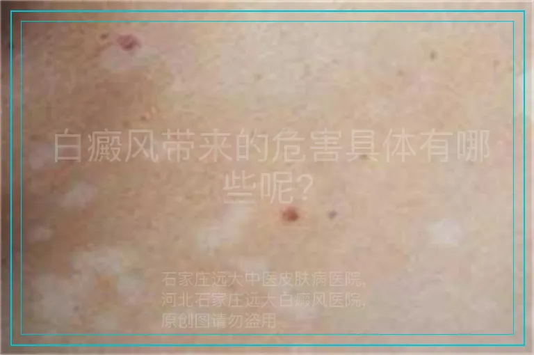 白癜风带来的危害具体有哪些呢?