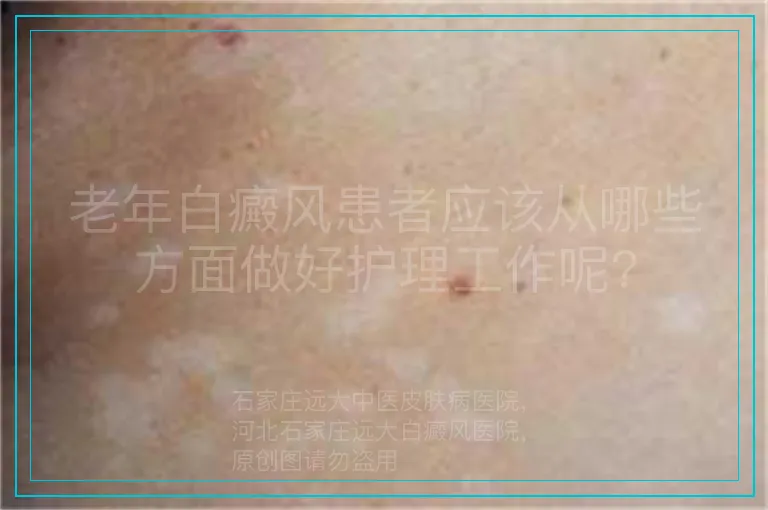 老年白癜风患者应该从哪些方面做好护理工作呢?