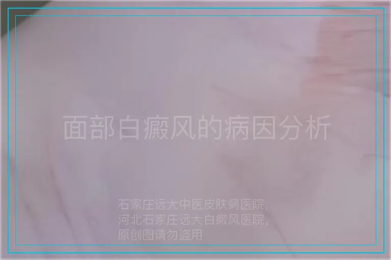 面部白癜风的病因分析