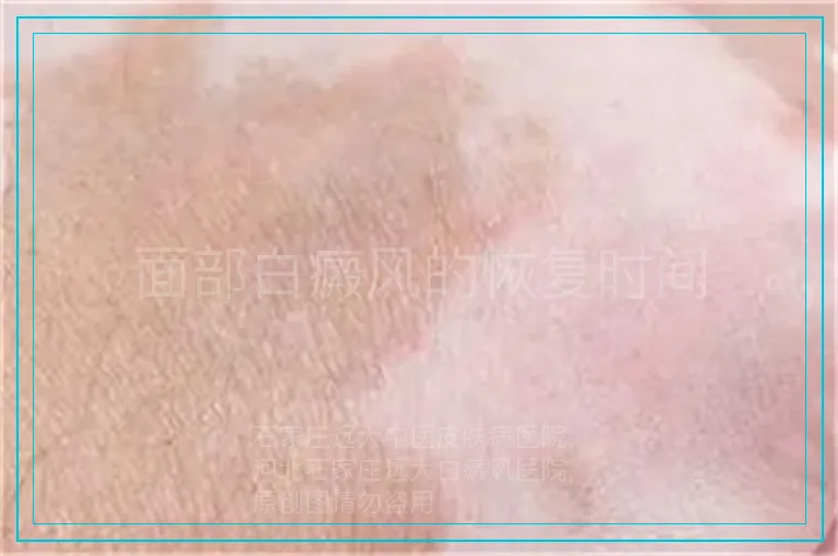 面部白癜风的恢复时间