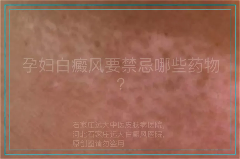 孕妇白癜风要禁忌哪些药物?
