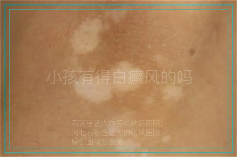 小孩有得白癜风的吗
