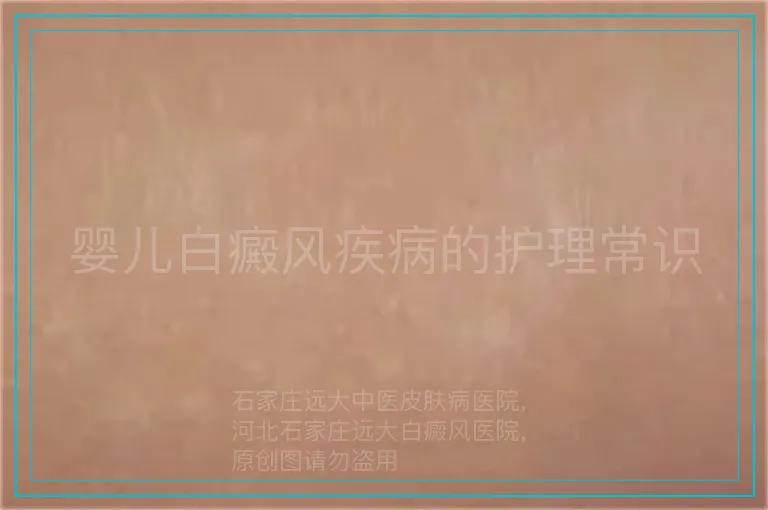 婴儿白癜风疾病的护理常识