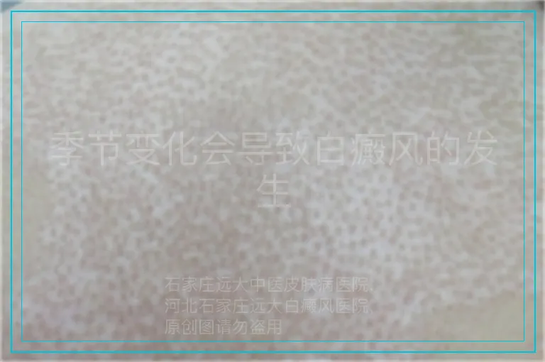 季节变化会导致白癜风的发生