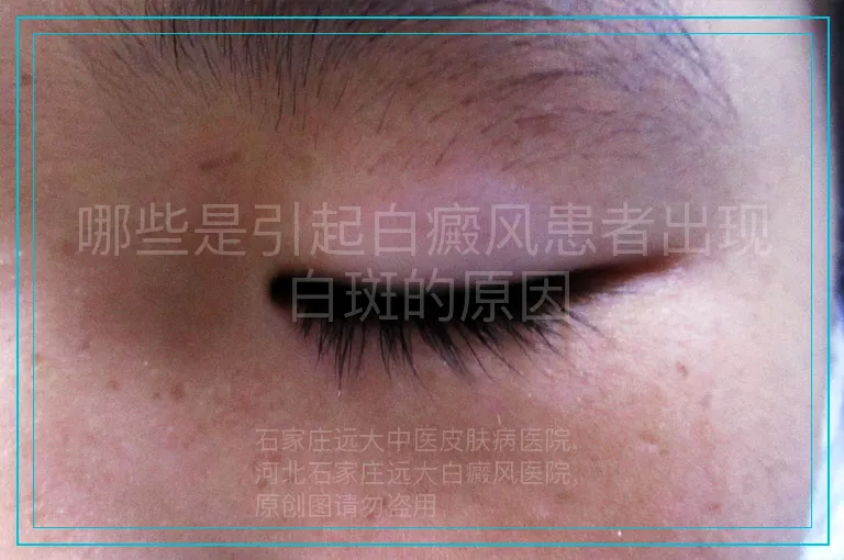 哪些是引起白癜风患者出现白斑的原因