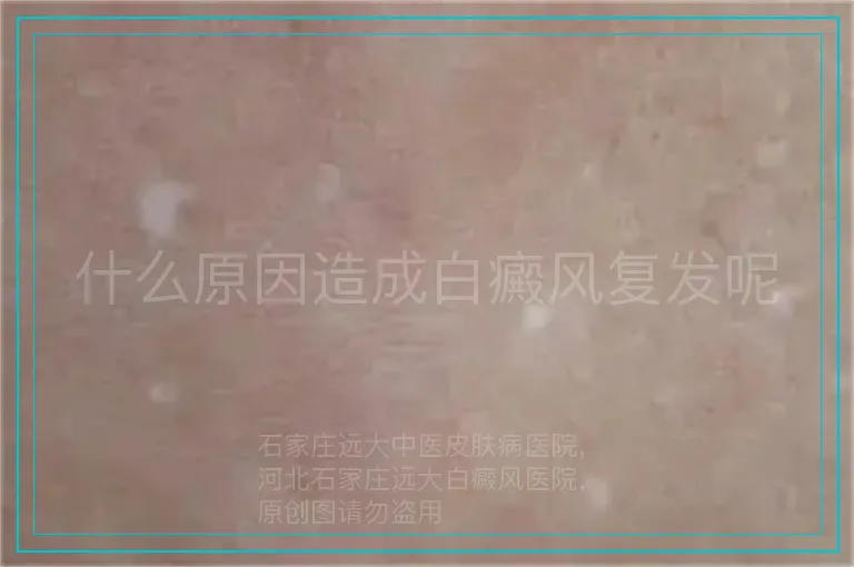 什么原因造成白癜风复发呢