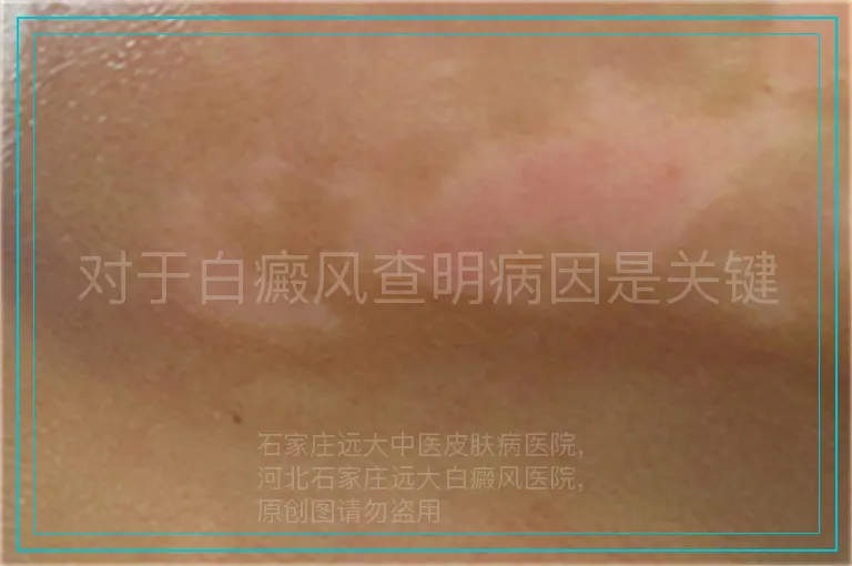 对于白癜风查明病因是关键