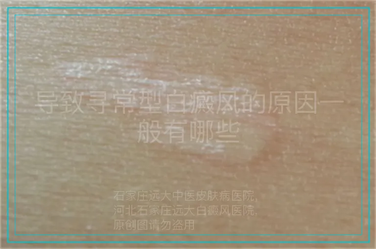 导致寻常型白癜风的原因一般有哪些