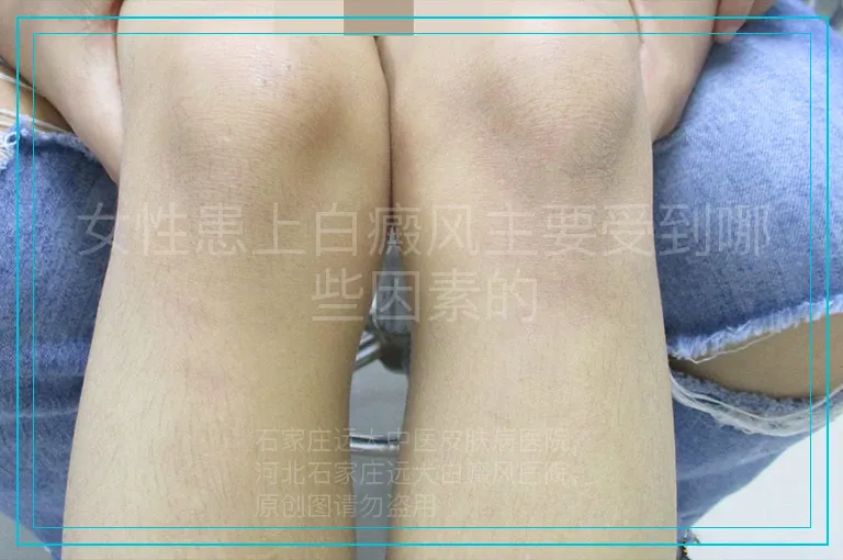 女性患上白癜风主要受到哪些因素的