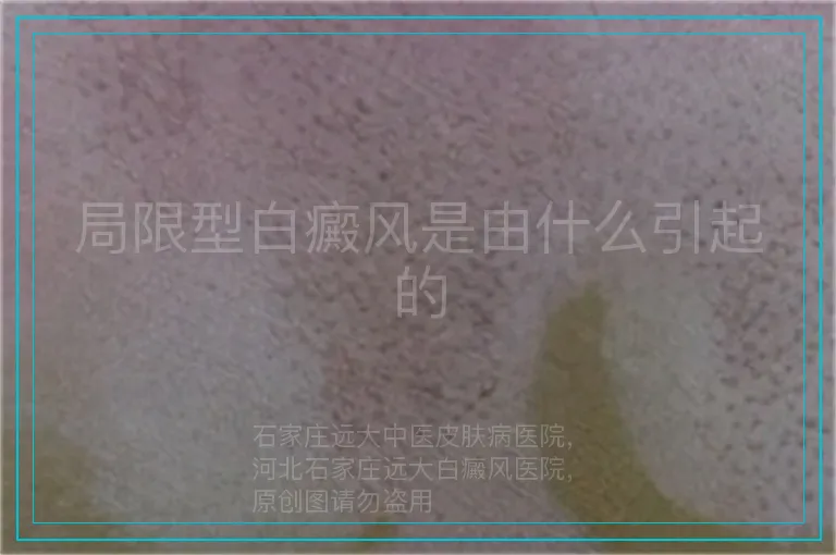 局限型白癜风是由什么引起的