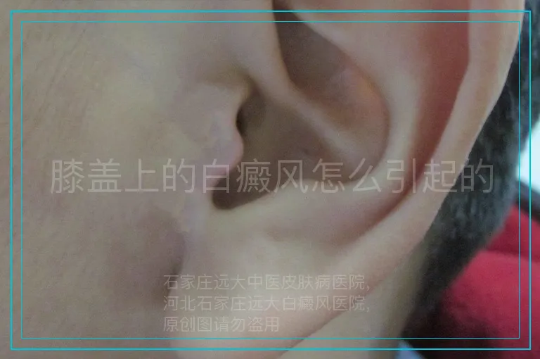 膝盖上的白癜风怎么引起的